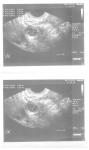 Срочная лапороскопия при кисте яичника неясного характера фото 2