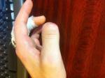 Удлинение фаланги большого пальца руки фото 2