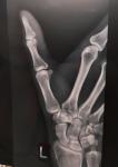 Рентген пальца фото 2