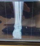 АНФ Hep2 1: 1280 положительный фото 5