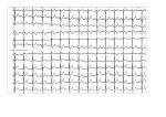 Неспецифическое нарушение в/желудочковой проводимости- нормально или нет? фото 2