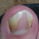 Повреждено ногтевое ложе фото 2