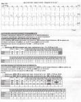 Систалическая аритмия фото 3