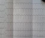 Сердцебиение, одышка, отеки, описание ЭКГ фото 2