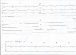 Что на ЭКГ? фото 1