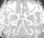 Расшифровка артерий головного мозга фото 3