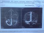 МРТ: Отсутствие визуализации кровотока по левой ярёмной вене фото 1