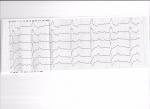 В анамнезе инфаркт миокарда 2008. Расшифровка ЭКГ и БХК фото 3