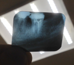 Есть ли гранулёма-киста в корнях 36 зуба фото 2