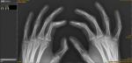 Есть ли патологии на рентгене кистей рук? фото 2