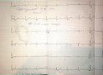 Плохое самочуствие. Коагулограмма. Общий анализ. ЭКГ фото 3