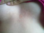Коричневые пятна на спине и возле груди фото 1