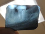 Есть ли гранулёма-киста в корнях 36 зуба фото 3