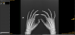 Есть ли патологии на рентгене кистей рук? фото 1