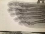 Перелом 4 палец правой ноги фото 3