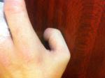 Удлинение фаланги большого пальца руки фото 5