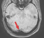 МРТ головного мозга, помогите разобраться (седло, сосудистая патология и инфаркт) фото 1