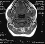МРТ при увеличении лимфоузлов фото 2