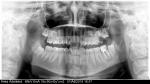 Боль в нижних зубах фото 1