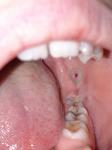 Боль языка, пятно на щеке, боюсь онкологии фото 4