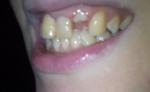 Какие варианты восстановления разрушенного зуба? фото 1