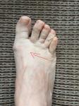 Боль в ноге в районе большого пальца и шишки фото 2