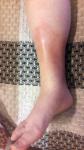 Покраснение на голени ноги и отечность фото 1