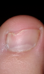 Подозрительная кожа на ногтях и пальцах фото 1