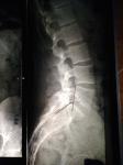 Признаки остеопороза позвоночника фото 1