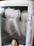 Зуб, переодонтит фото 1