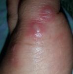 Болячки на большом пальце ноги фото 1