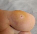 Красная пузырь под кожей на большом пальце ноги фото 1