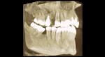 Киста зуба, консультация по снимку фото 1