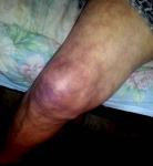 Синеют и болят колени фото 1