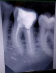 Ноет зуб после лечения фото 1