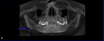 Расшифровка рентгенограммы зубов фото 1