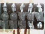 Перелом мыщелка большеберцевой кости фото 1
