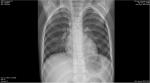 Описание рентгена грудной клетки фото 1