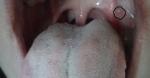Пупырышки в горле возле нёбной дужки фото 2
