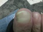 Потемнение ногтевой пластины на ноге фото 1