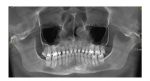 2 зуба подвижны после брекетов, в одном трещина фото 2