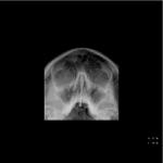 Заложенность носа, есть рентген и расшифровка фото 1