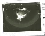 Эндометриоидная киста и планирование зачатия (ЭКО) фото 2