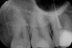 Зуб реагирует на холодное фото 1