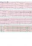 Замирание сердца, расшифровка кардиограммы фото 1