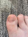 Вертикальная полоса на ногте большого пальца ноги фото 1