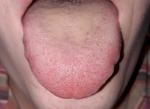 Боль языка, пятно на щеке, боюсь онкологии фото 2
