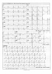 Помогите расшифровать ЭКГ, консультация кардиолога онлайн фото 2
