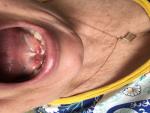 Воспаление в полости рта фото 2