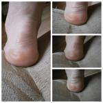 Проблема ног, мазоль или грибок. Как лечить? фото 1